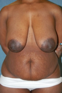 Breast Enhancement and Tummy Tuck Patient 39346 Before Photo # 1