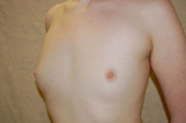 Breast Augmentation Patient 92231 Before Photo # 1