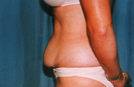 Tummy Tuck Patient 15918 Before Photo # 5