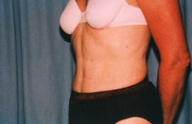Tummy Tuck Patient 65833 After Photo # 4