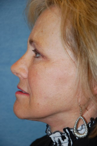 Face Lift and Neck Lift Patient 49297 After Photo # 6