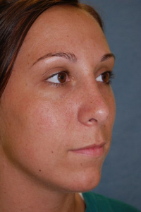 Chin Augmentation Patient 68370 After Photo # 6