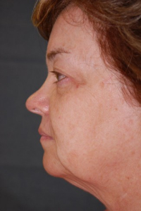 Face Lift and Neck Lift Patient 27540 Before Photo # 5