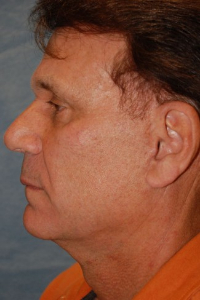 Facial Surgery - (Men) Patient 20588 After Photo # 4