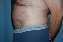Tummy Tuck Patient 95680 After Photo # 6