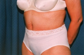 Tummy Tuck Patient 19101 After Photo # 4