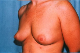 Breast Augmentation Patient 90070 Before Photo # 3
