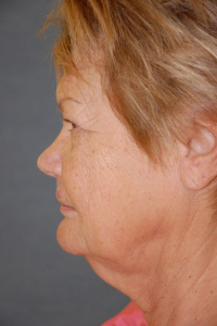 Face Lift and Neck Lift Patient 74597 Before Photo # 5