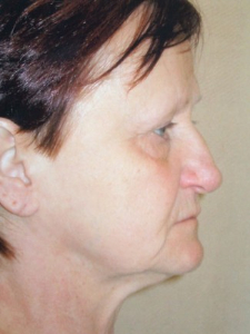 Eye Lift - Blepharoplasty Patient 14431 Before Photo # 3