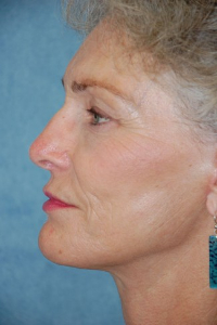 Face Lift and Neck Lift Patient 89542 After Photo # 4