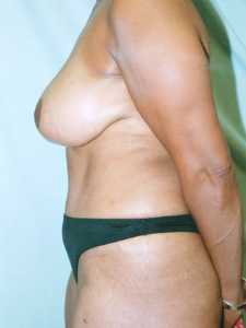 Breast Enhancement and Tummy Tuck Patient 83357 After Photo # 2