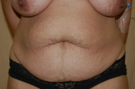 Tummy Tuck Patient 56117 Before Photo # 1