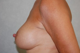 Breast Augmentation Patient 42926 After Photo # 4