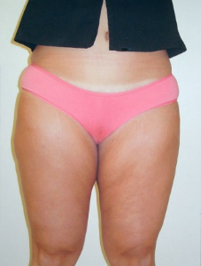 Liposuction Patient 53168 After Photo # 2