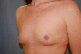 Breast Augmentation Patient 34919 Before Photo # 3