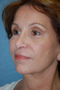 Face Lift and Neck Lift Patient 18954 After Photo # 4