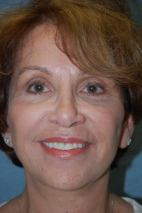 Eye Lift - Blepharoplasty Patient 52177 After Photo # 2