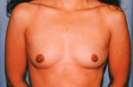 Breast Augmentation Patient 16566 Before Photo # 1
