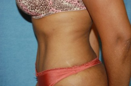 Tummy Tuck Patient 55304 After Photo # 6