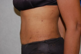 Liposuction Patient 62658 After Photo # 6