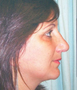 Rhinoplasty Patient 26636 After Photo # 2