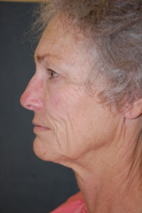 Face Lift and Neck Lift Patient 89542 Before Photo # 3