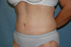 Tummy Tuck Patient 43806 After Photo # 2