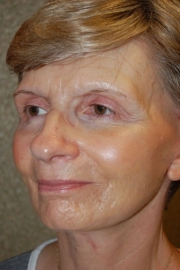 Face Lift and Neck Lift Patient 11276 After Photo # 4