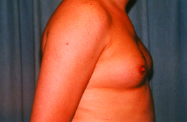 Gynecomastia Patient 93696 Before Photo # 5