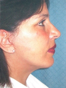 Face Lift and Neck Lift Patient 30136 After Photo # 2