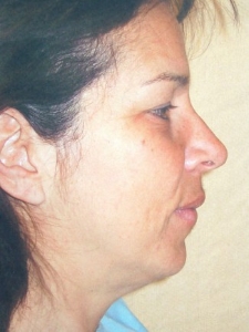 Eye Lift - Blepharoplasty Patient 26561 Before Photo # 1