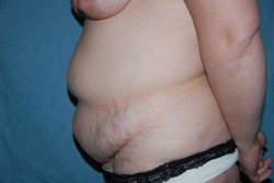 Tummy Tuck Patient 31799 Before Photo # 5