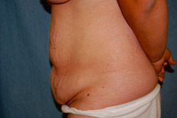 Tummy Tuck Patient 43806 Before Photo # 3