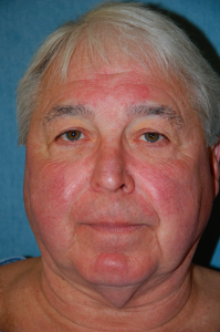 Facial Surgery - Men Patient 91240 Before Photo # 1
