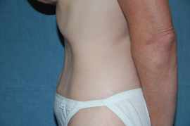 Mini Tummy Tuck Patient 65699 After Photo # 6