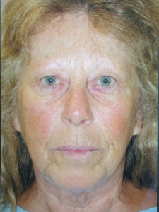 Face Lift and Neck Lift Patient 85131 Before Photo # 1