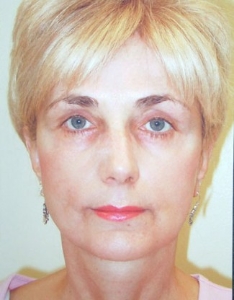 Face Lift and Neck Lift Patient 40143 After Photo # 6
