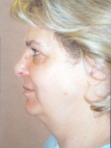 Face Lift and Neck Lift Patient 33637 Before Photo # 9