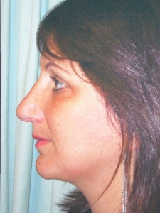 Face Lift and Neck Lift Patient 21688 After Photo # 4
