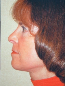 Face Lift and Neck Lift Patient 56718 After Photo # 2