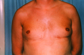 Gynecomastia Patient 93696 After Photo # 2