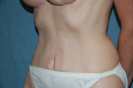 Mini Tummy Tuck Patient 65699 After Photo # 4