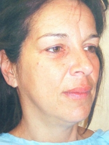 Eye Lift - Blepharoplasty Patient 26561 Before Photo # 3