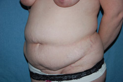Tummy Tuck Patient 31799 Before Photo # 3