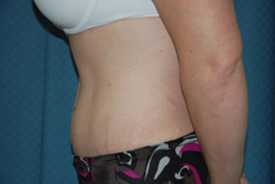 Tummy Tuck Patient 31799 After Photo # 6