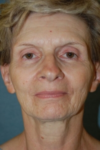 Face Lift and Neck Lift Patient 11276 Before Photo # 1