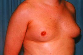 Gynecomastia Patient 93696 Before Photo # 3