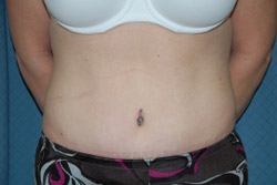 Tummy Tuck Patient 31799 After Photo # 2