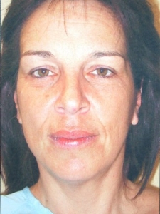 Eye Lift - Blepharoplasty Patient 26561 Before Photo # 5