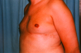 Gynecomastia Patient 93696 After Photo # 4